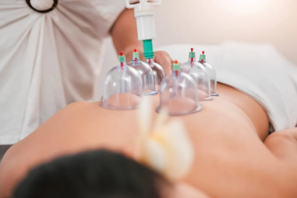 Cupping therapy