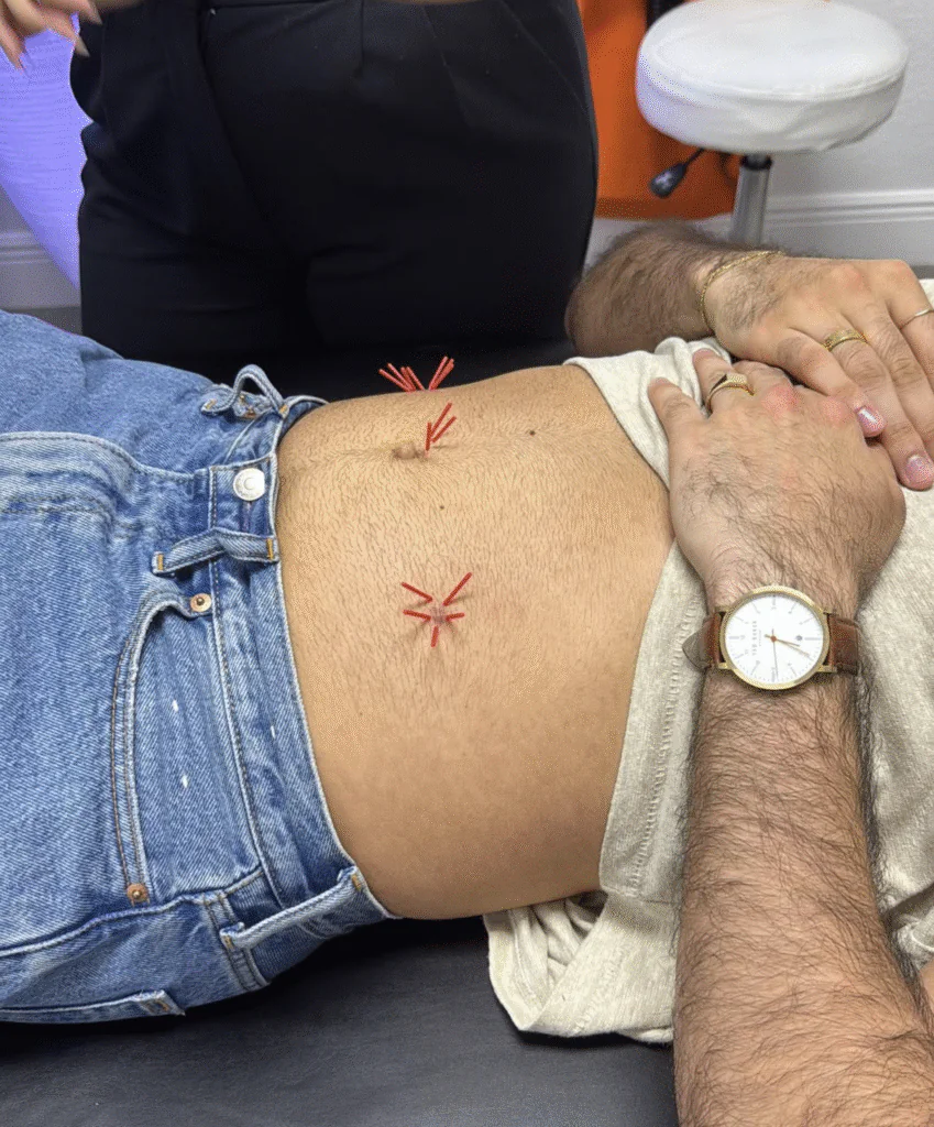 Chiropractic Adjustments with Acupuncture