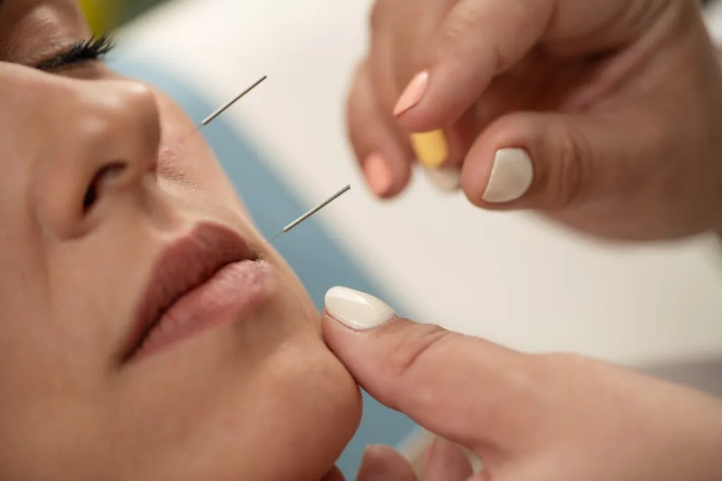 Choosing Acupuncture Over Botox