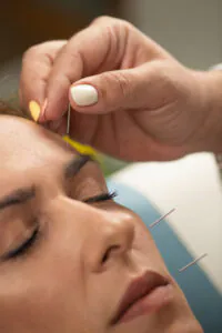 Choosing Acupuncture Over Botox