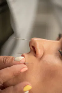Choosing Acupuncture Over Botox