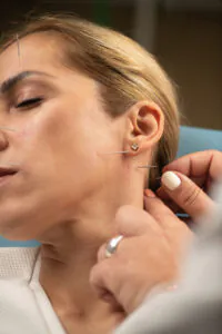 Choosing Acupuncture Over Botox