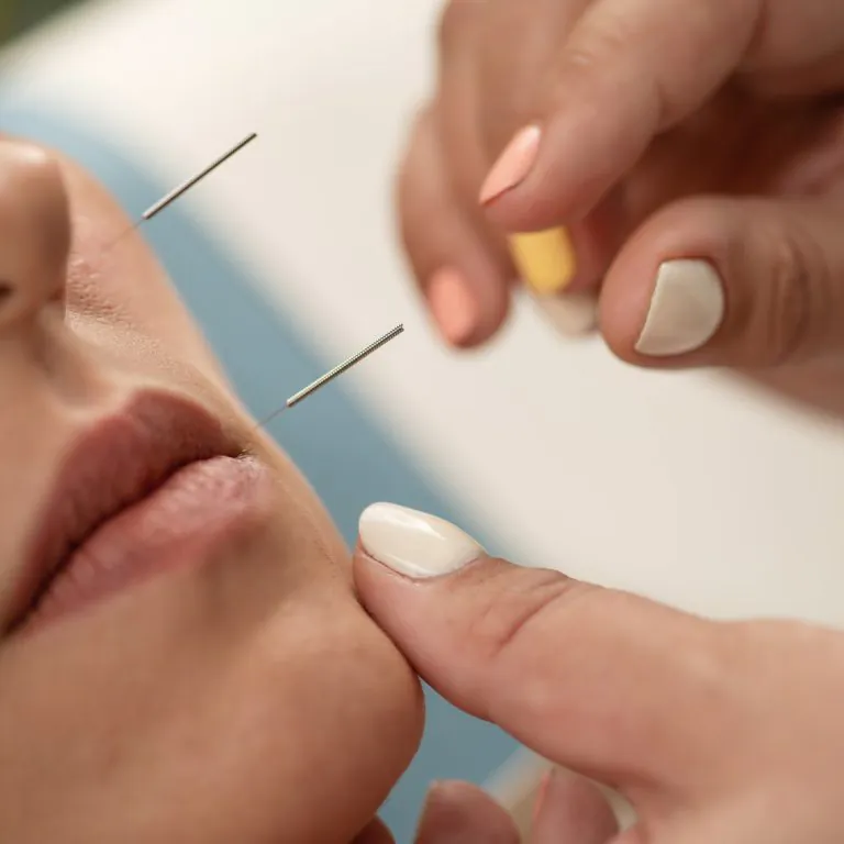 Choosing Acupuncture Over Botox